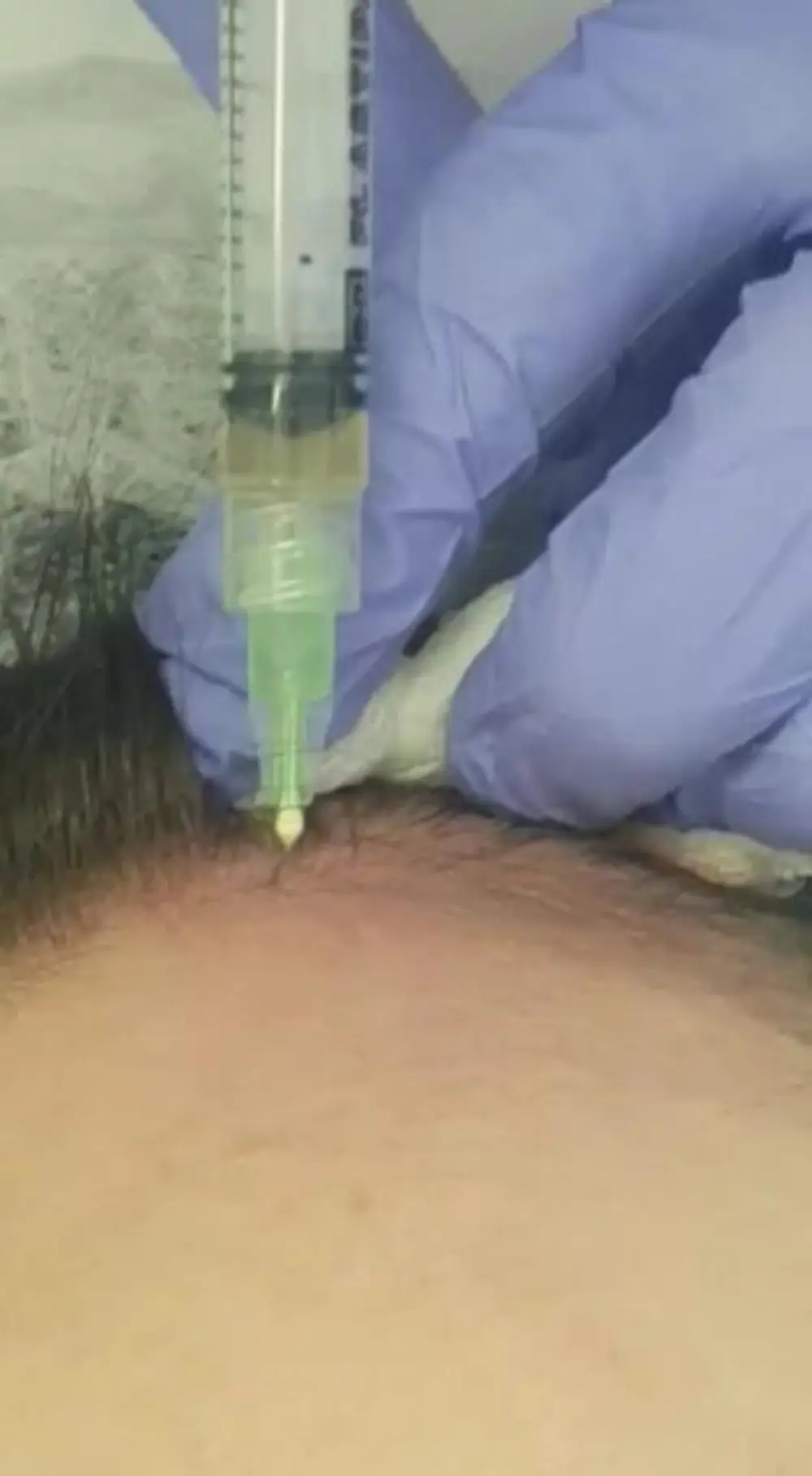 Prp hair injection
