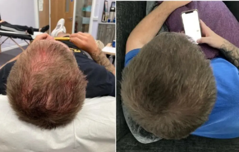 Prp hair before after