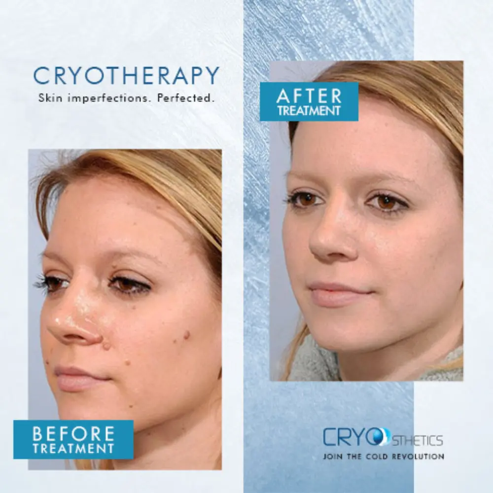 Beforeandafter cryotherapy6