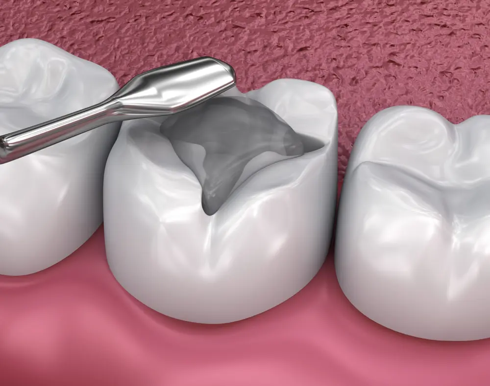 A dental procedure showing a tooth with cavity filling, with dental tools and neighboring teeth on pink gums in a close-up view.