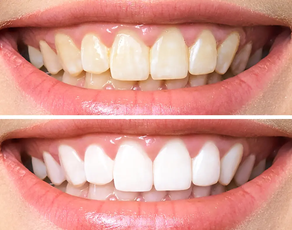 Before and after teeth cleaning comparison, featuring a close-up of a person's smile with visible teeth, lips, and surrounding skin.