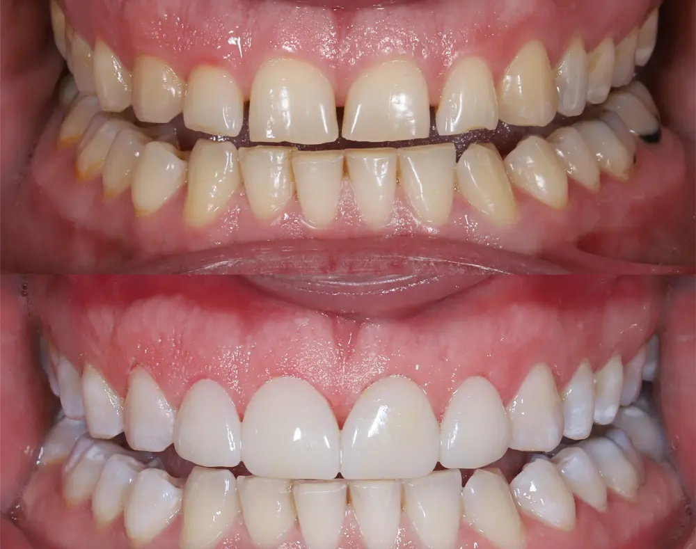 A close-up of a person's mouth showing upper and lower teeth with some gaps and misalignment, with pink gums surrounding the teeth.