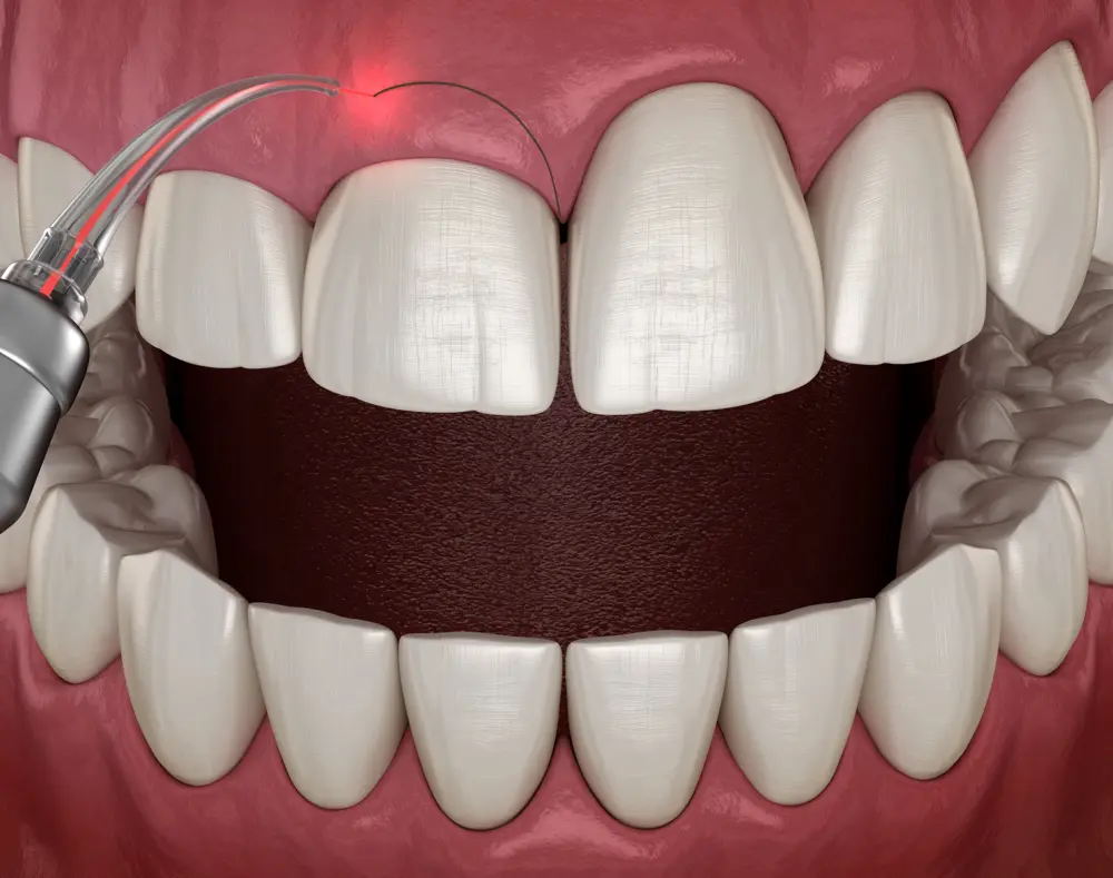 Close-up of a dental laser tool targeting a patient's upper front teeth during a dental procedure, with the mouth wide open showing the interior.