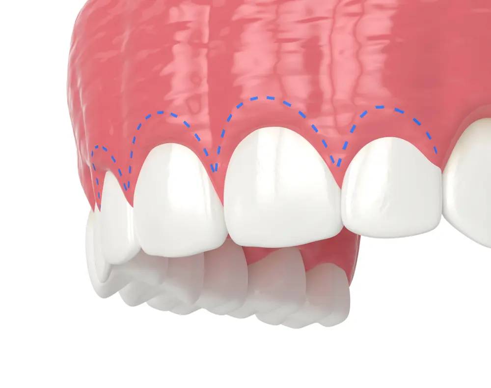Gum line with blue dashed lines indicating the gum recession or contouring area over the teeth.