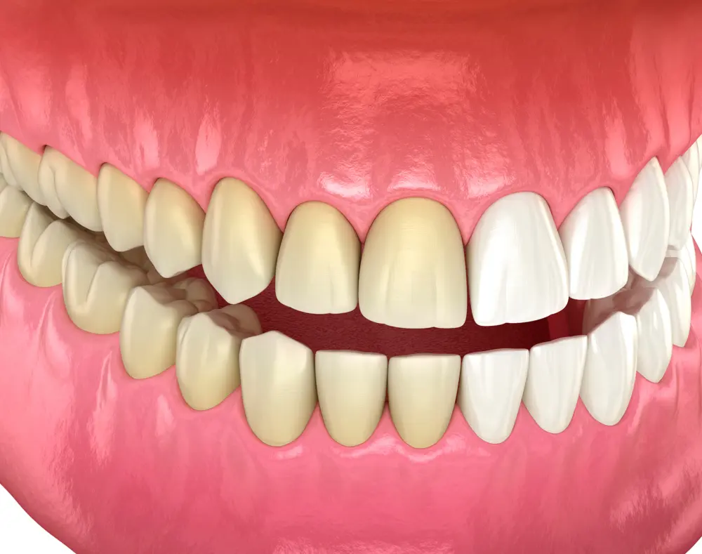 Close-up of a set of teeth with some natural discoloration, showing both upper and lower rows with pink gums and a slightly open mouth.