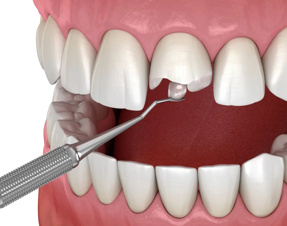 A dental instrument near a broken front tooth with exposed dentin and pulp, surrounded by healthy teeth and gums in an open mouth.