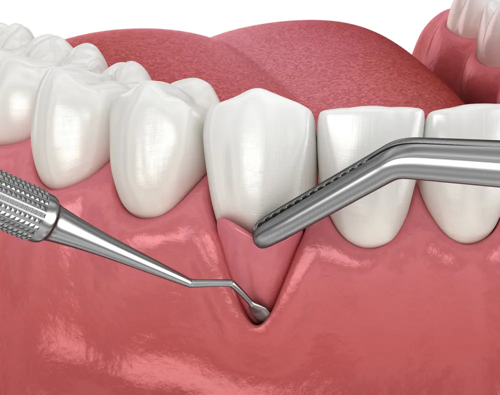 Close-up of dental cleaning tools working on teeth and gums during oral hygiene procedure.