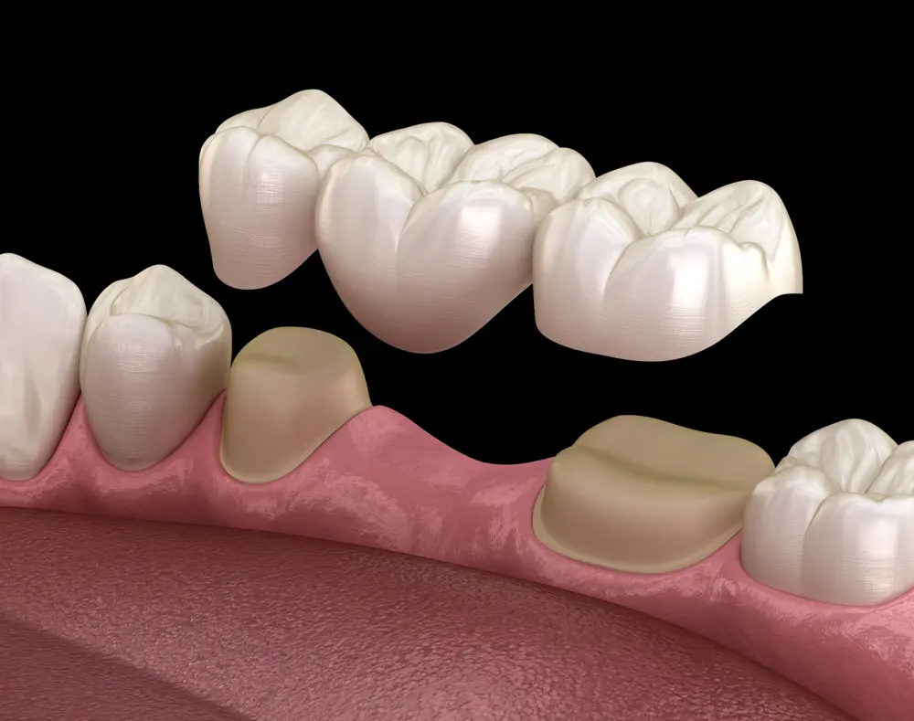 Animated illustration of teeth with dental crowns, showing a close-up of the upper teeth and gums against a black background.
