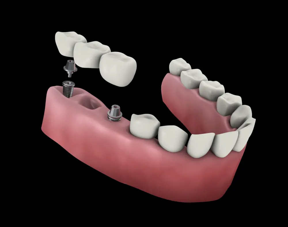 A digital illustration showing a dental implant procedure with a lower jaw, dental implants, and artificial teeth being fitted into the jaw.