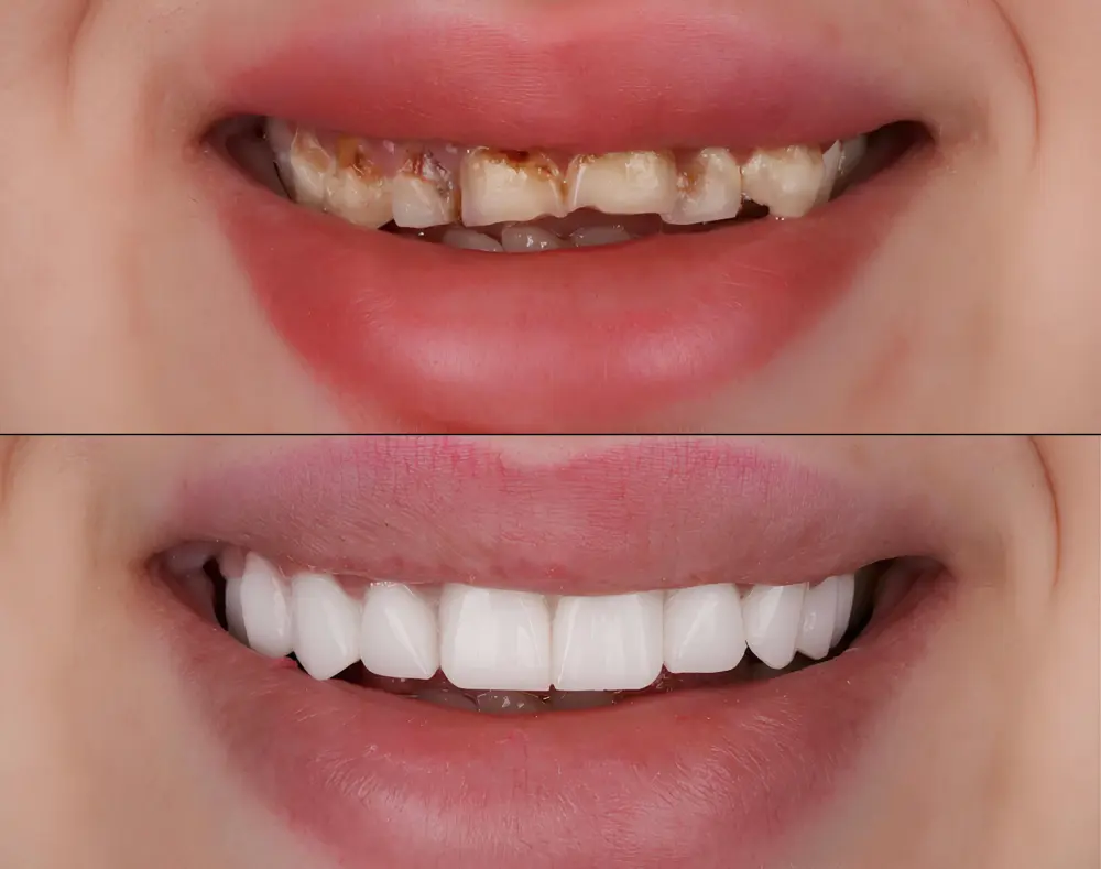 Comparison of teeth showing severe decay and cleaning, with the cleaned teeth appearing bright, white, and healthy in the bottom image.
