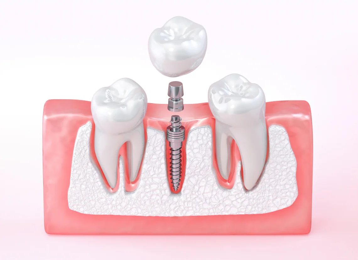 A dental implant procedure showing a screw-like implant anchored in the gum with a crown being placed on top of the implant between two natural teeth.