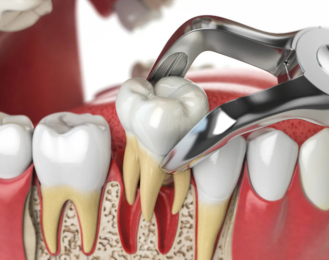 A dental instrument removes decay from a molar tooth during a dental procedure, with surrounding teeth and gums visible in the illustration.