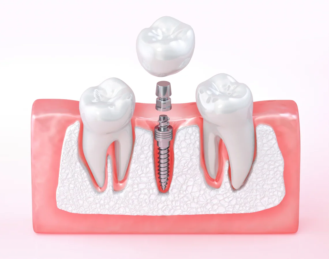 Dental implant procedure showing a screw in the jawbone, with two molars and an abutment ready for the crown placement over the implant.