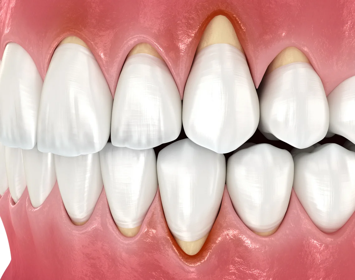 Close-up of a set of clean, white teeth with pink gums, showing the upper and lower front teeth in a slightly open mouth.