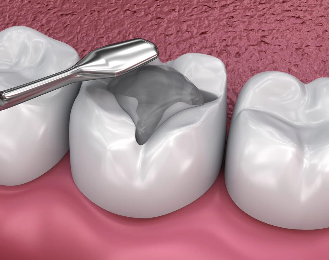 A close-up of a dental procedure with a dental drill removing decay from a molar tooth, surrounded by other healthy teeth and pink gums.