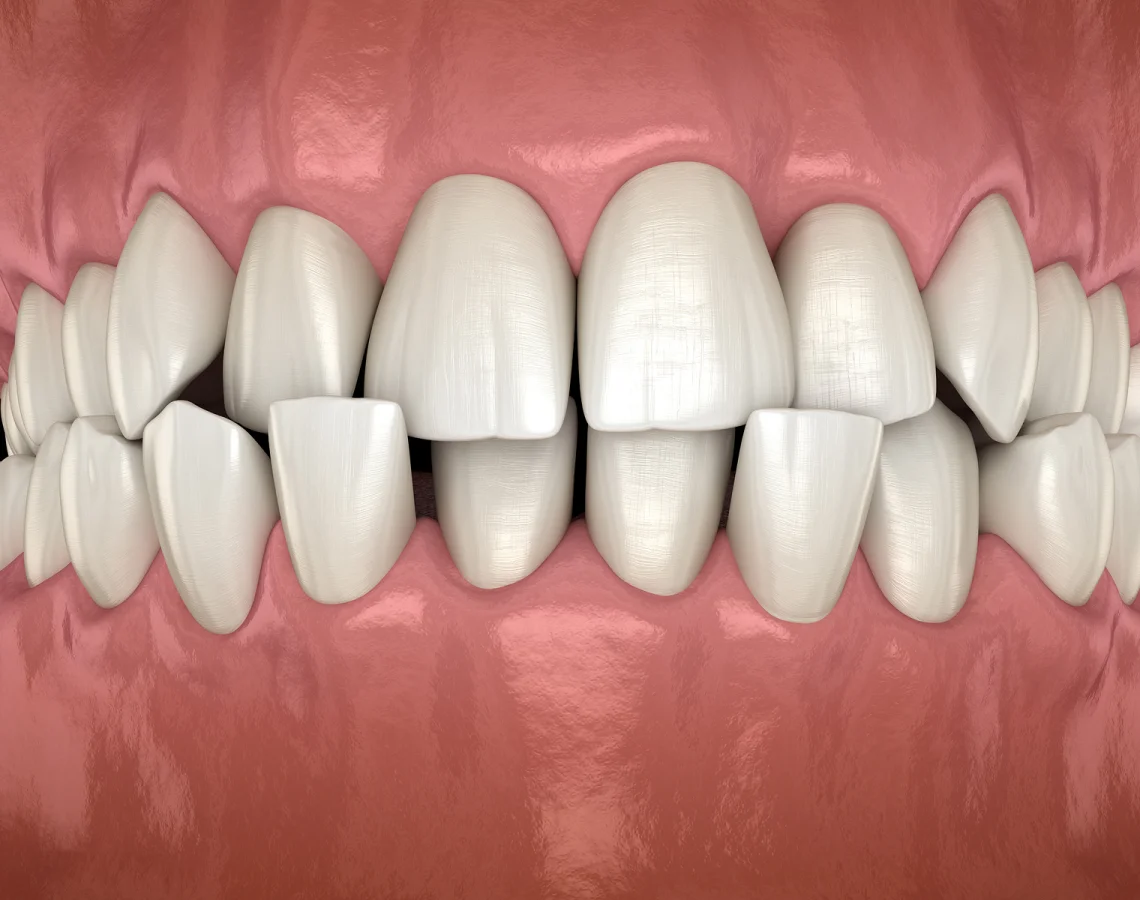 Close-up of a set of upper and lower teeth with some misalignment, showing the gums and oral mucosa in the background.