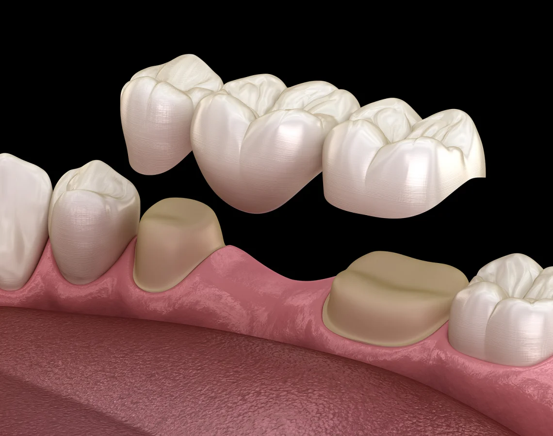 Animated illustration of teeth with dental crowns, showing a close-up of the upper teeth and gums against a black background.