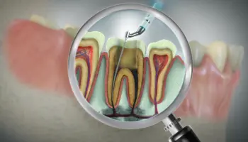 Root canal