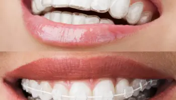 Clear aligner vs bracket