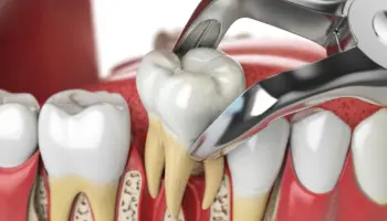 A dental instrument removes decay from a molar tooth during a dental procedure, with surrounding teeth and gums visible in the illustration.