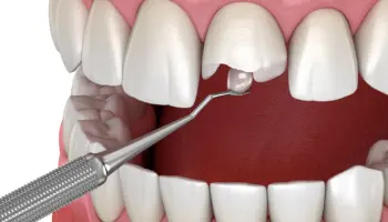 A dental instrument near a broken front tooth with exposed dentin and pulp, surrounded by healthy teeth and gums in an open mouth.