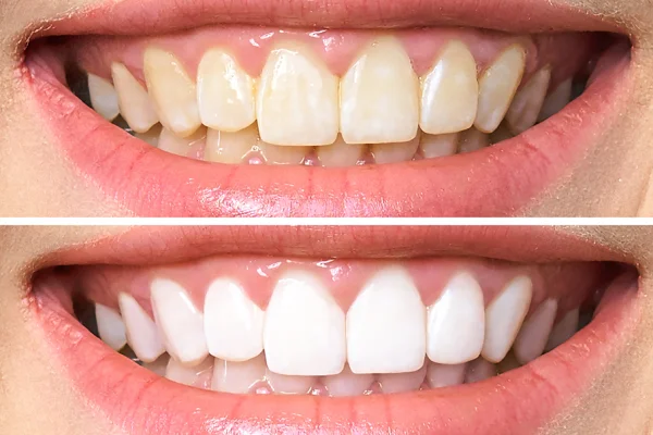 A close-up of a person's smile, showing before and after images of teeth whitening, with the upper image displaying stained teeth and the lower with whiter teeth.