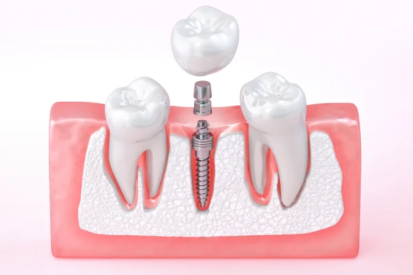 A dental implant procedure showing a screw-like implant anchored in the gum with a crown being placed on top of the implant between two natural teeth.