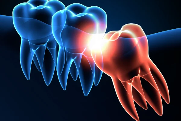 Illustration of a row of teeth, with one affected by pain or inflammation highlighted in red, against a dark background.