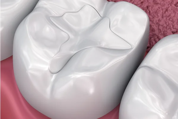 Close-up of a tooth with a star-shaped cavity filled with a shiny, white dental filling, on pink gum tissue.