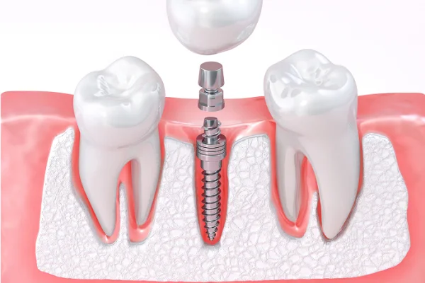 Dental implant procedure with a screw in the jawbone, a metal abutment, and a crown placed on top of a natural tooth in the gums.