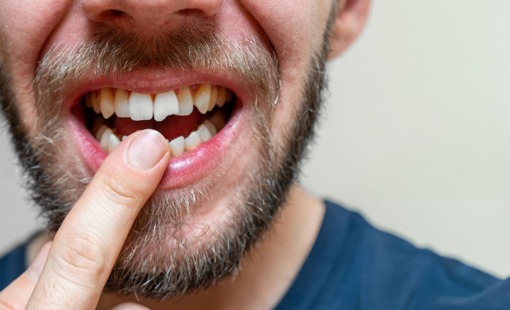 Can a Broken Tooth Be Repaired?