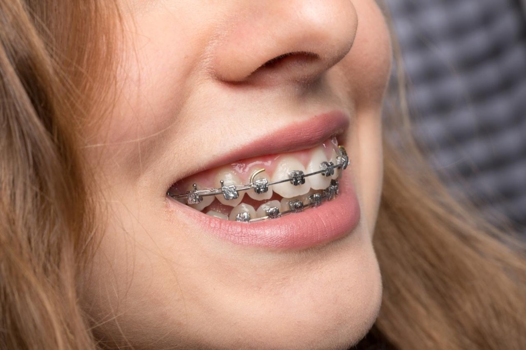 Clear Aligners and Fixed Braces