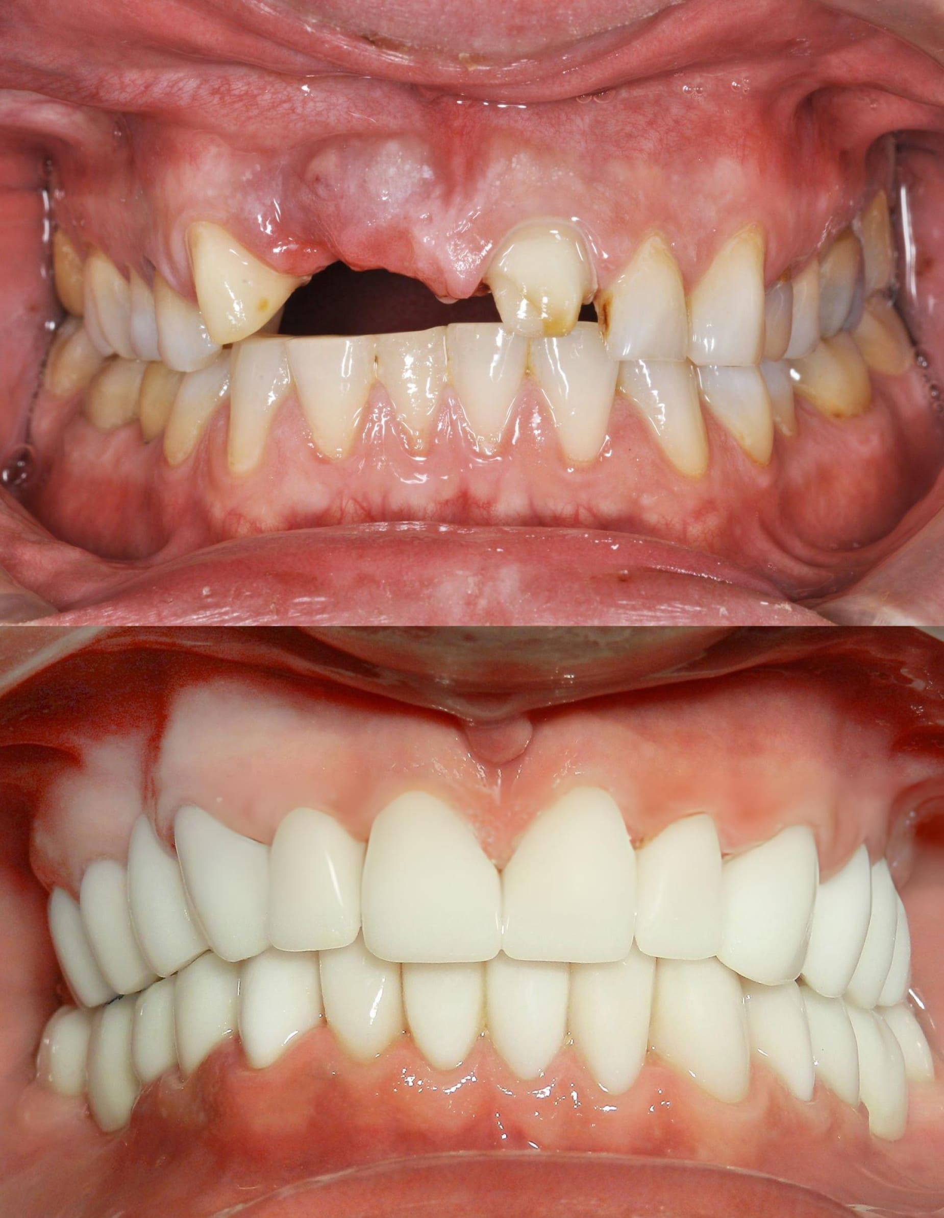 Full Smile Makeover