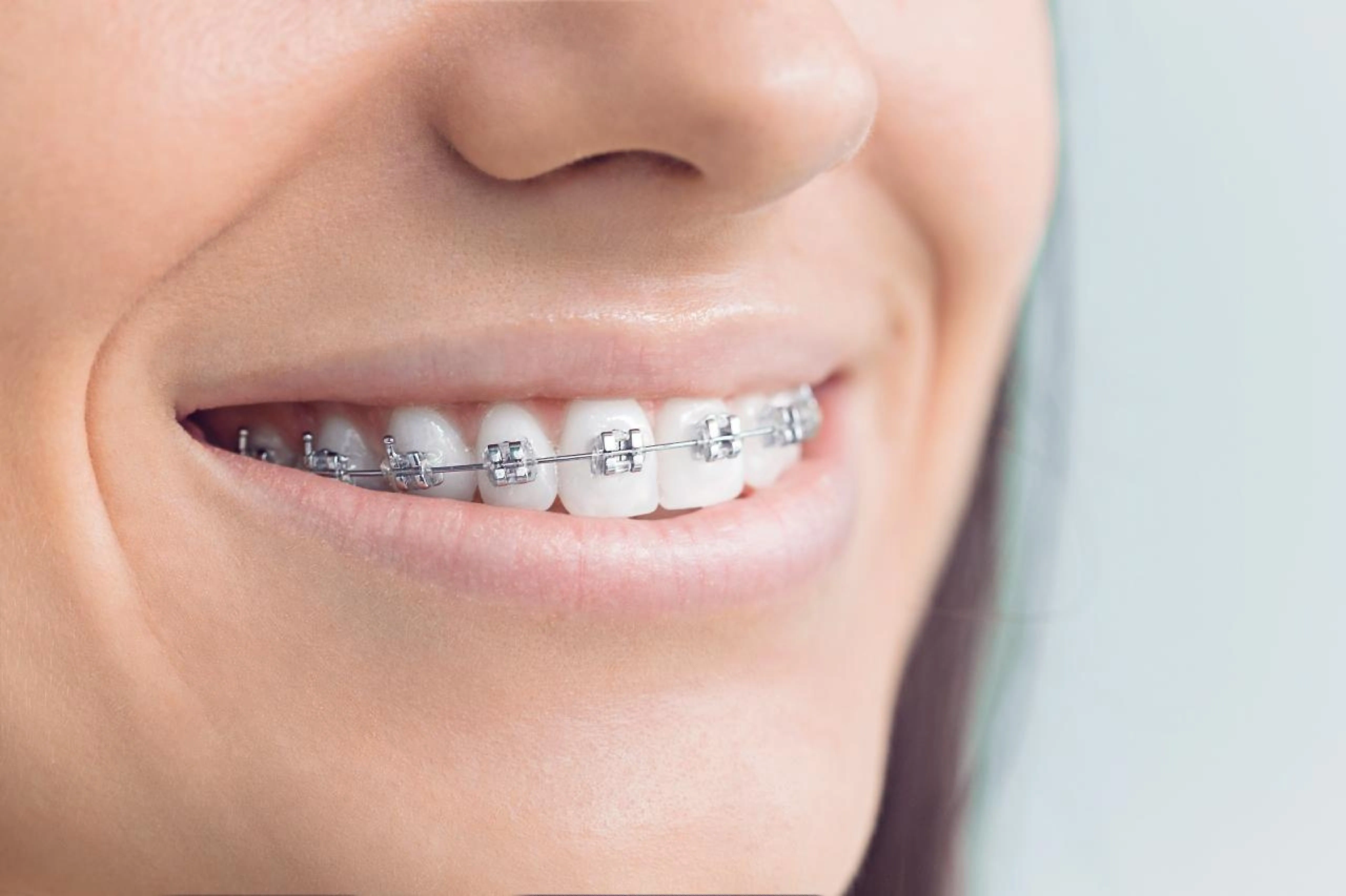 Are Braces Worth the Cost? What Basingstoke Patients Should Know