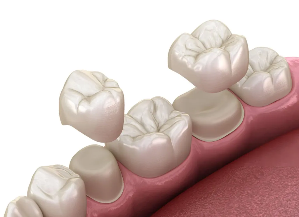 Dental Crowns