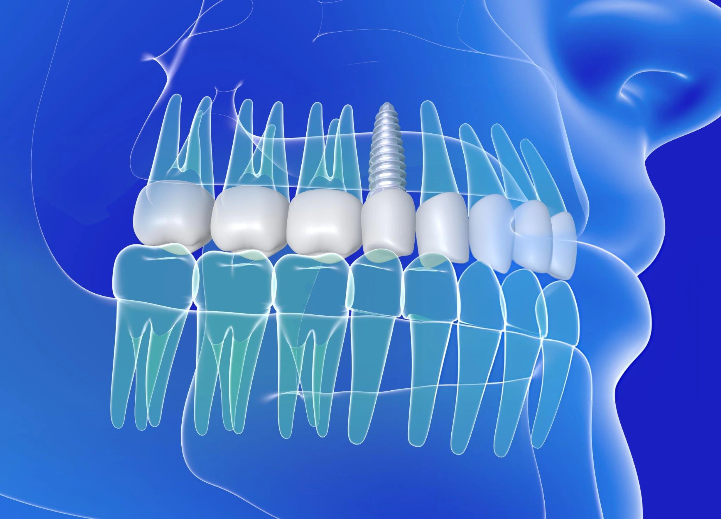 Dental Implants