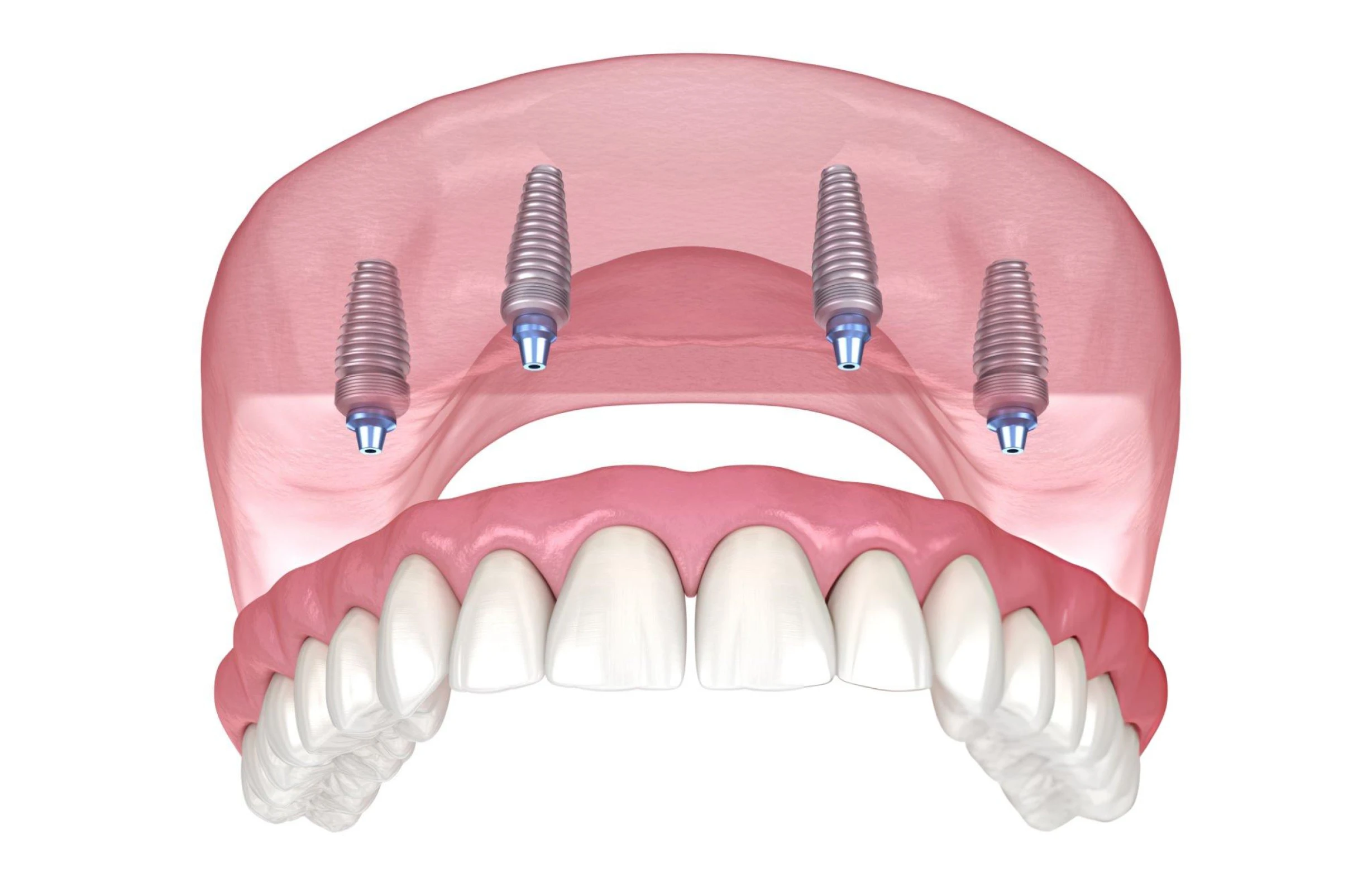 Implant-Retained Dentures (All-on-4 / Overdentures)