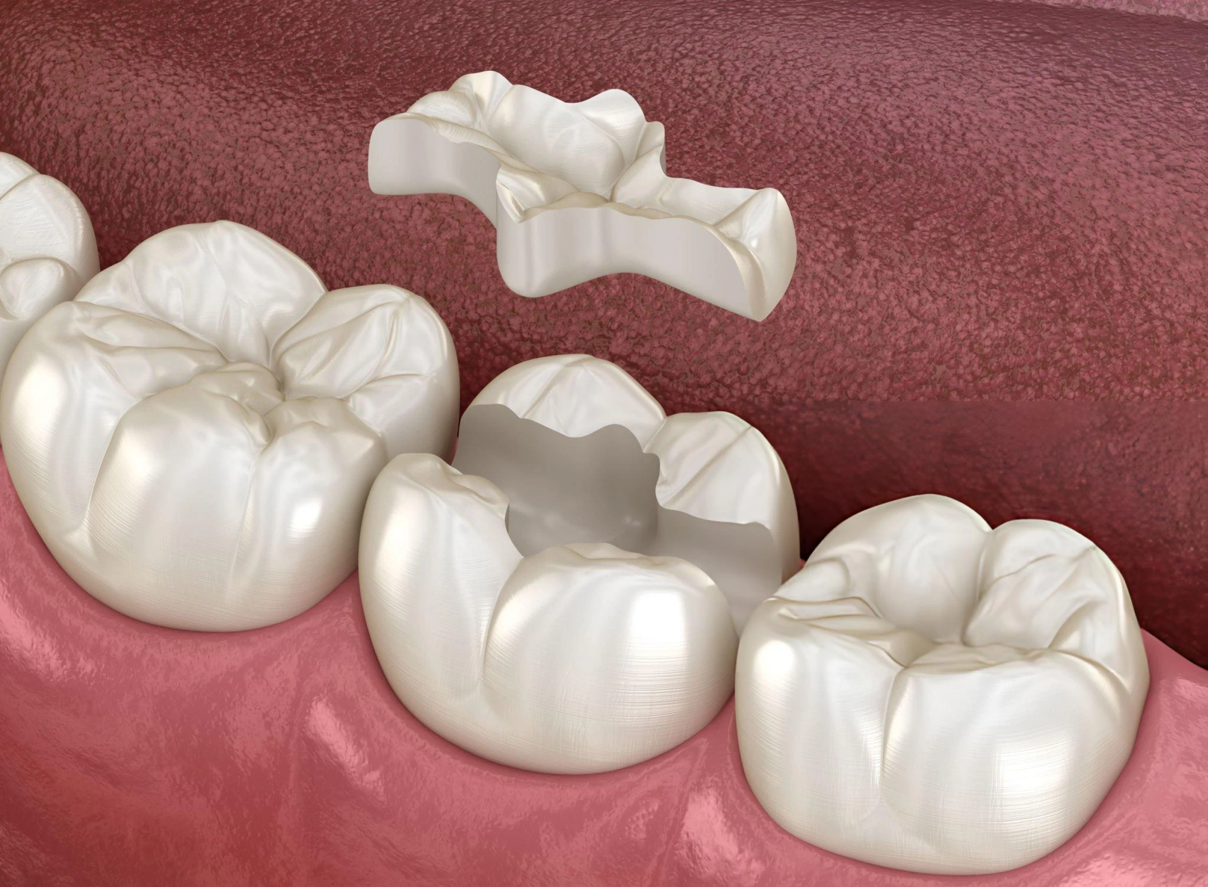 Dental Inlays & Onlays