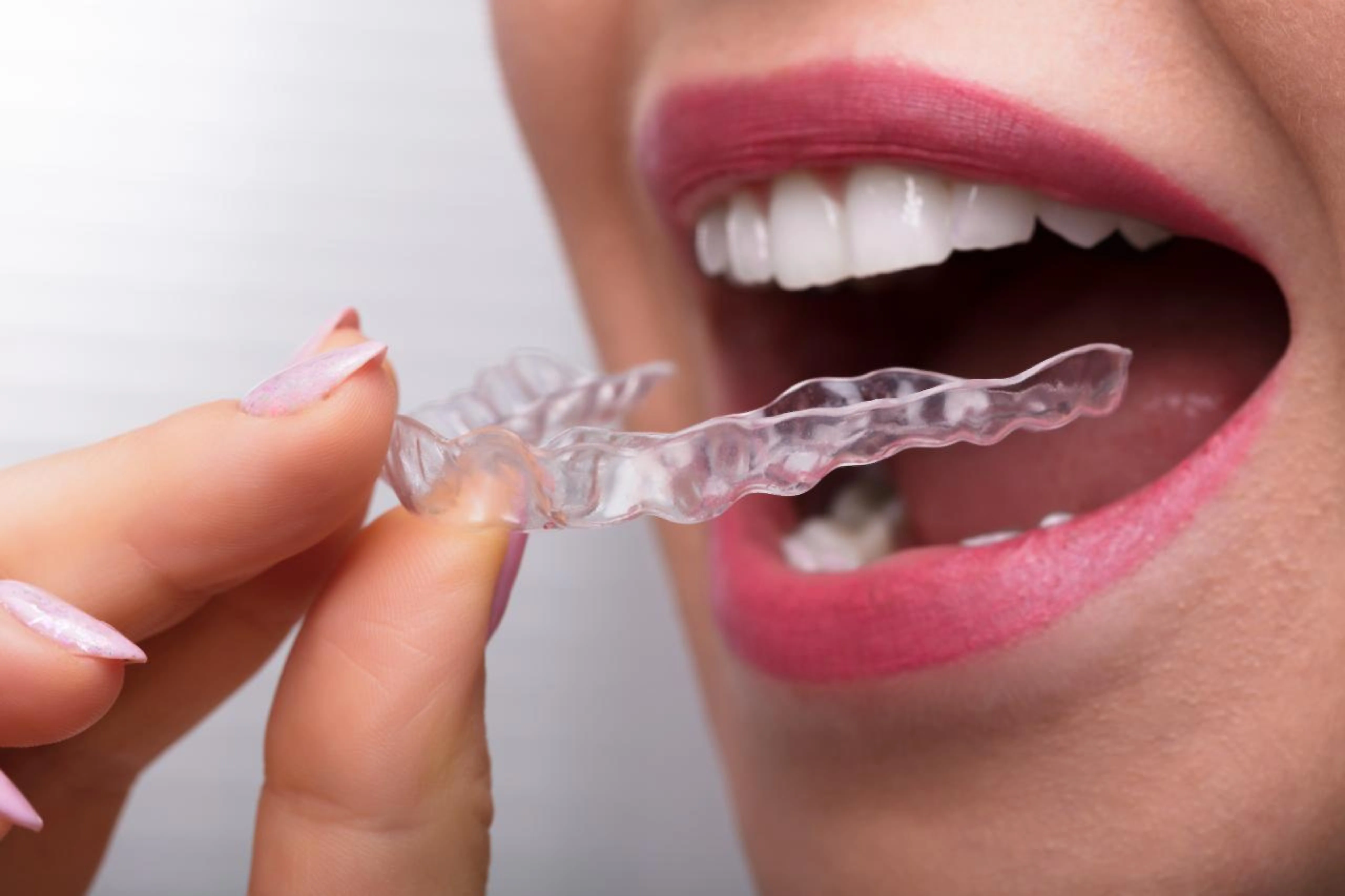 Invisalign SmartTrack Clear Aligners Showcase