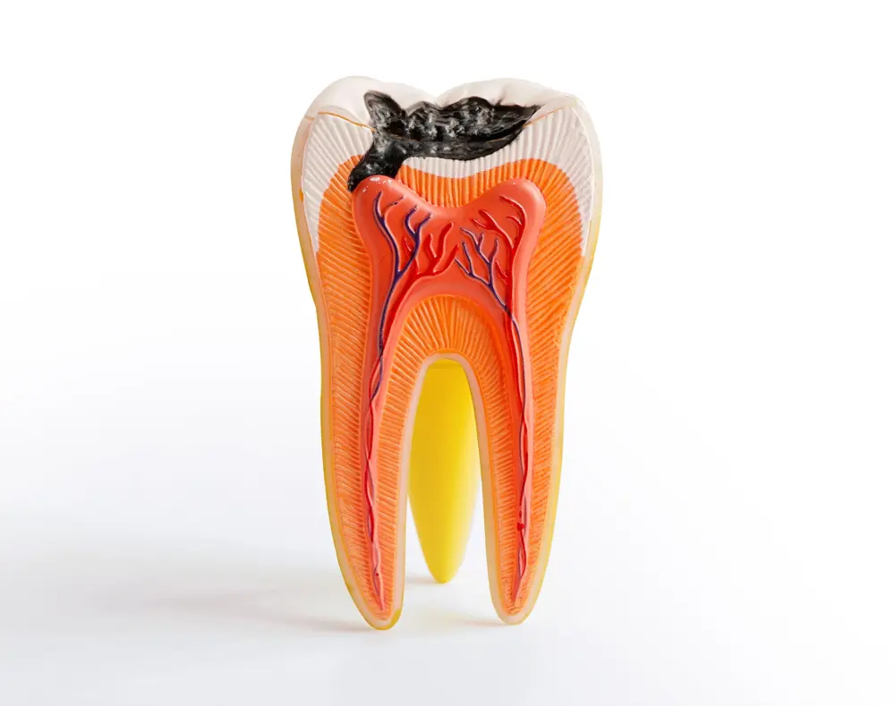 Root Canal Treatments
