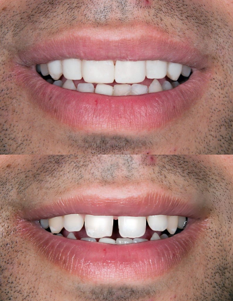 Same Day Smile Makeover
