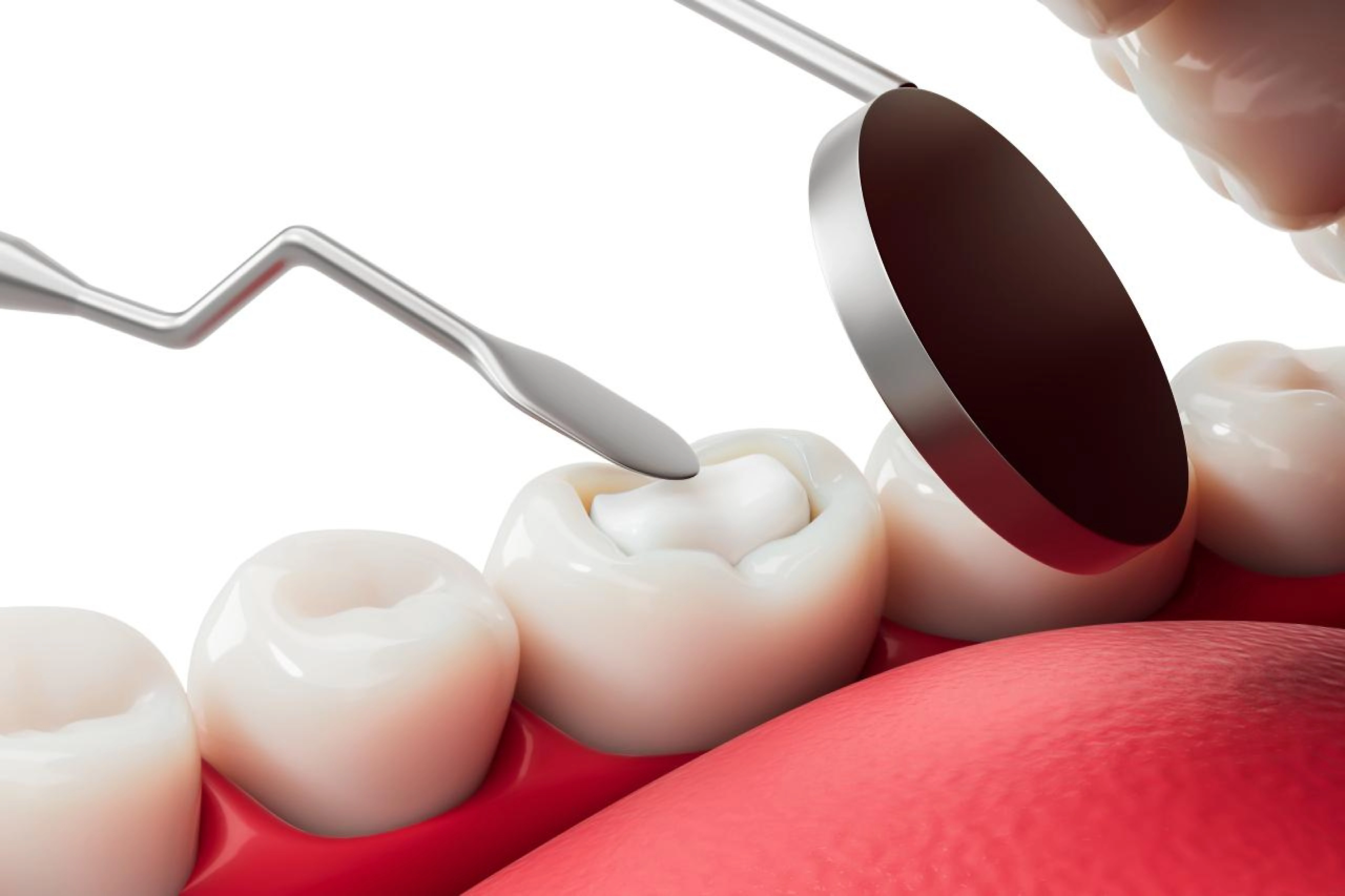 Tooth-Coloured White Fillings