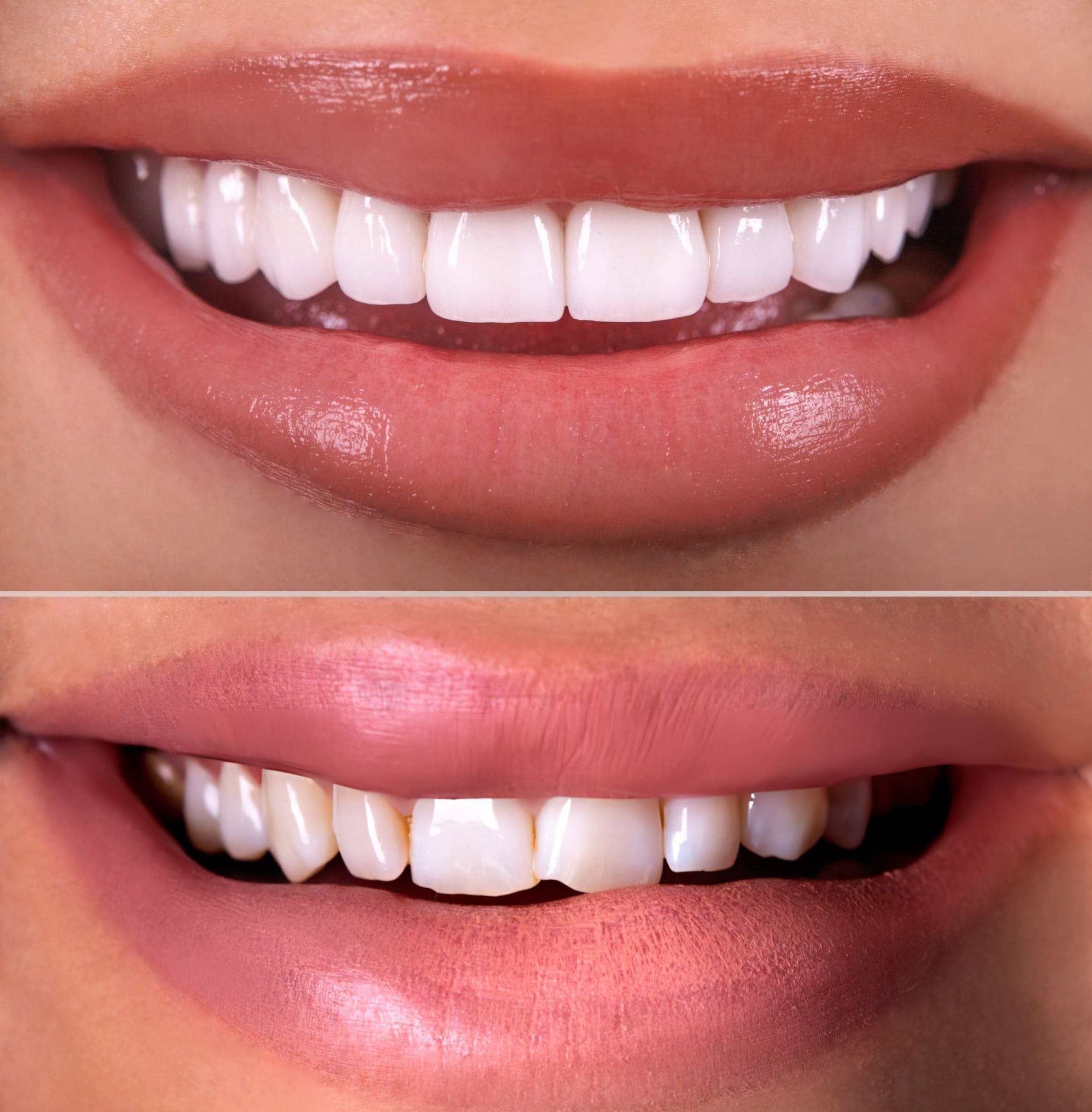 Mini Smile Makeover