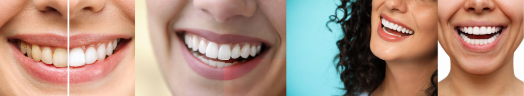 Smile Makeover Transformations